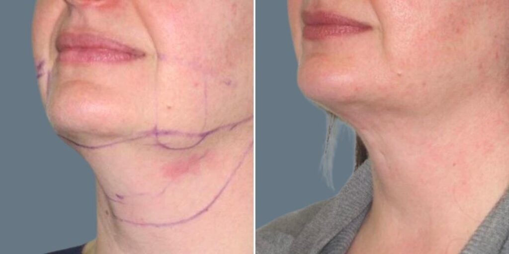 Skin Neck Liposuction Lift Female Pre2024 031 Before And After