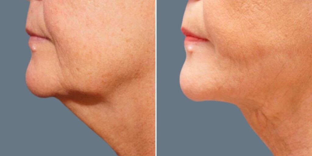 Skin Neck Liposuction Lift Female Pre2024 032 Before And After