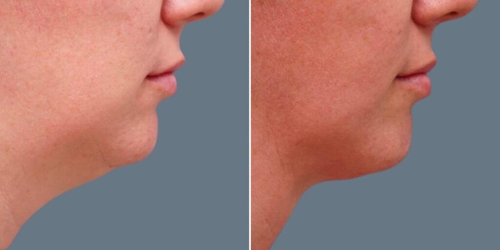 Skin Neck Liposuction Lift Female Pre2024 033 Before And After