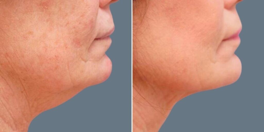 Skin Neck Liposuction Lift Female Pre2024 034 Before And After