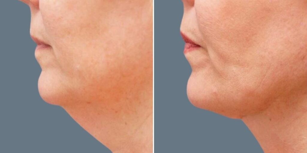 Skin Neck Liposuction Lift Female Pre2024 035 Before And After