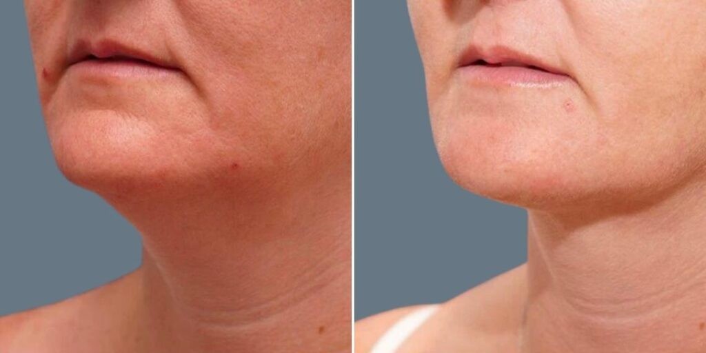 Skin Neck Liposuction Lift Female Pre2024 036 Before And After