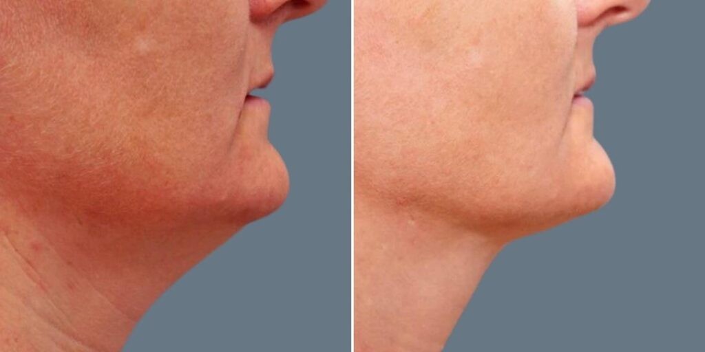 Skin Neck Liposuction Lift Female Pre2024 037 Before And After