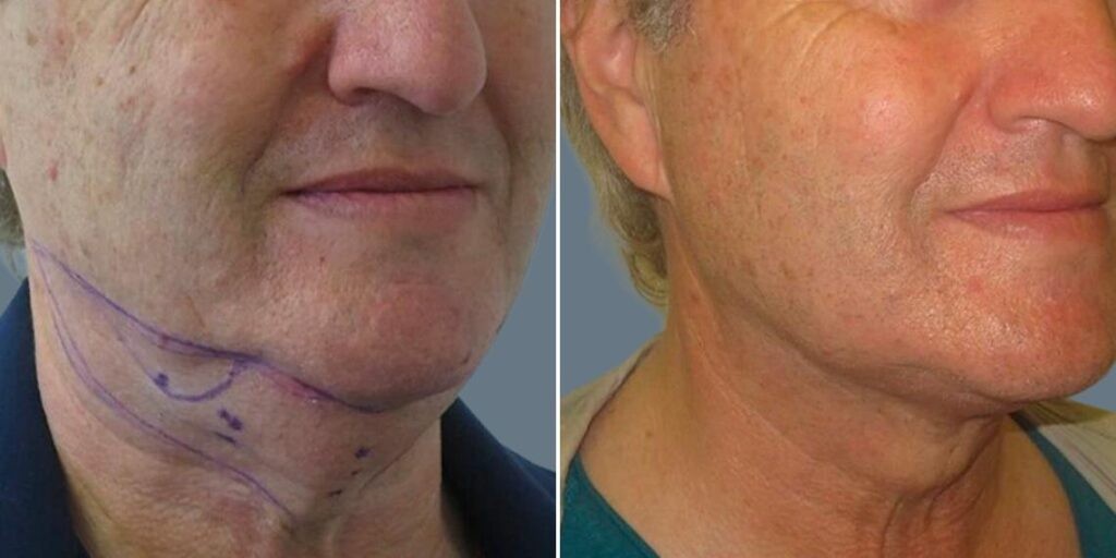Skin Neck Liposuction Lift Male Pre2024 020 Before And After