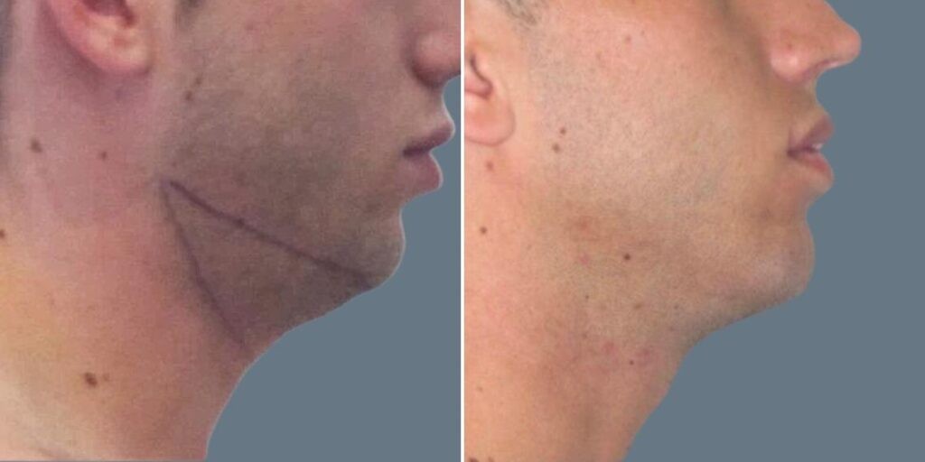 Skin Neck Liposuction Lift Male Pre2024 021 Before And After