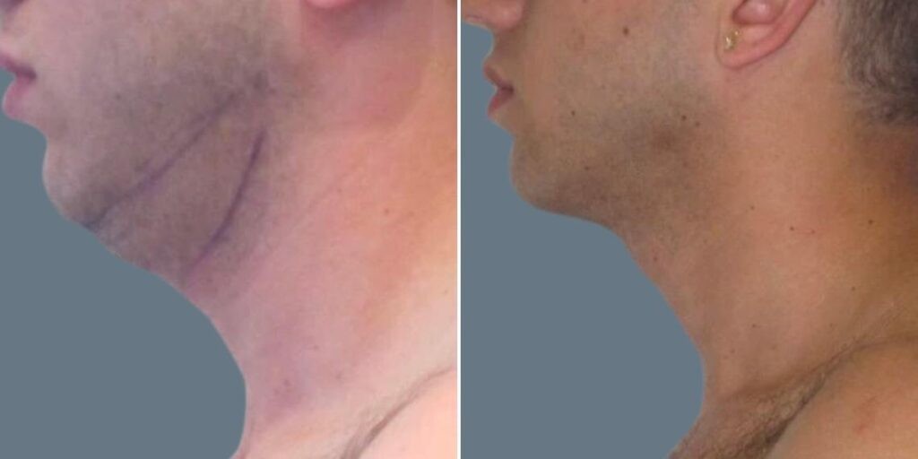 Skin Neck Liposuction Lift Male Pre2024 025 Before And After