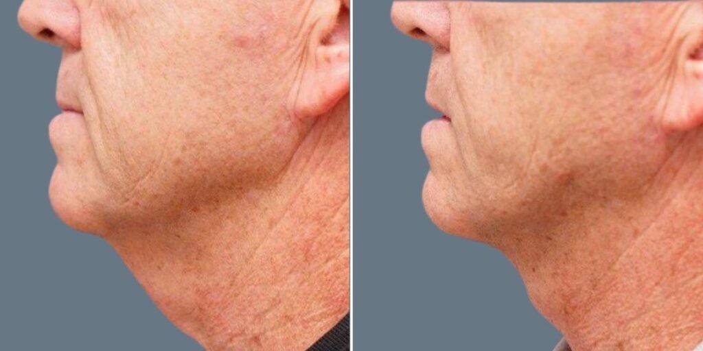 Skin Neck Liposuction Lift Male Pre2024 041 Before And After