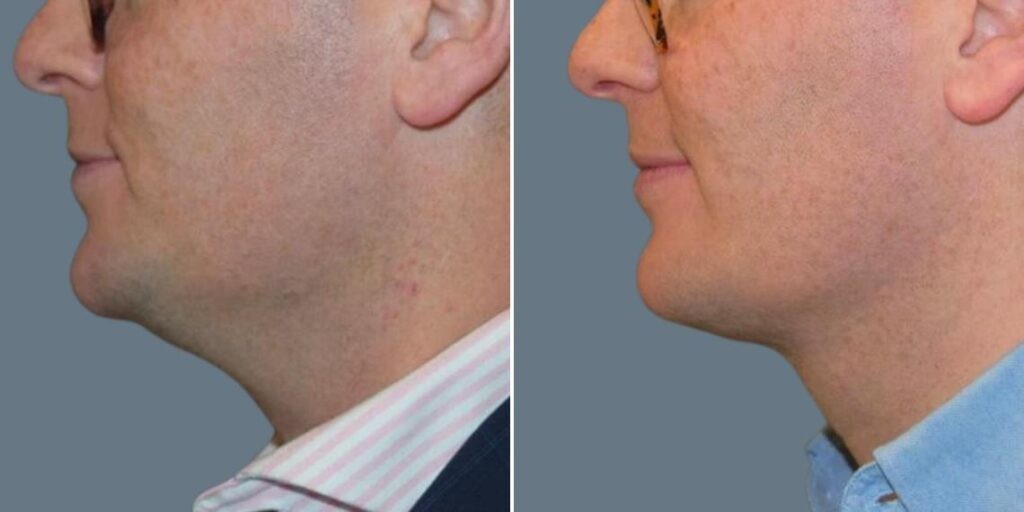Skin Neck Liposuction Lift Male Pre2024 049 Before And After