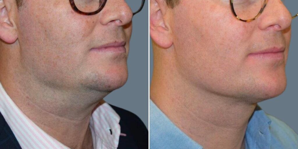 Skin Neck Liposuction Lift Male Pre2024 050 Before And After
