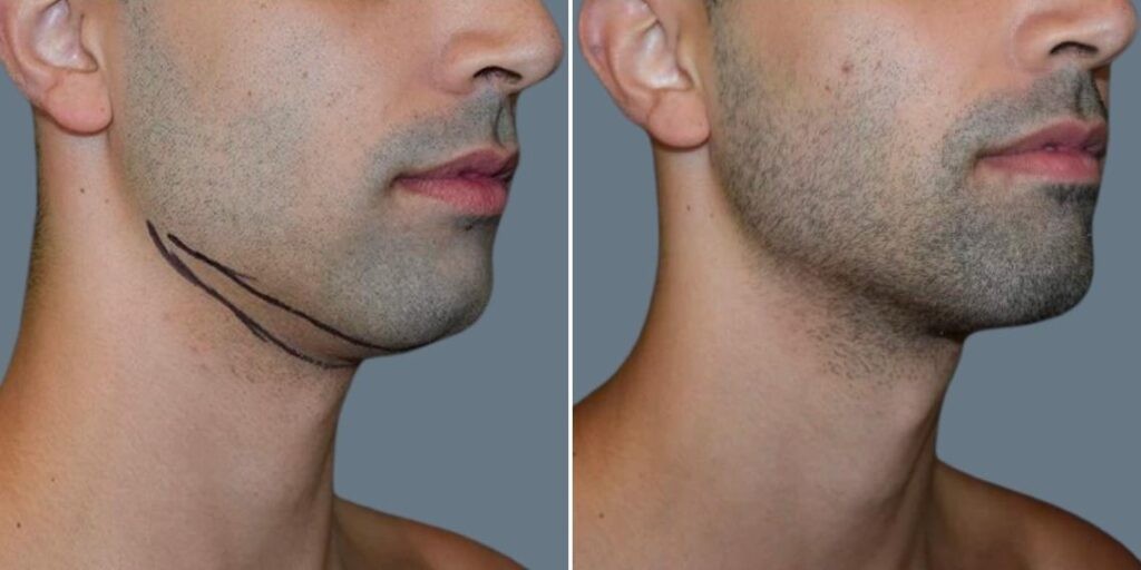 Skin Neck Liposuction Lift Male Pre2024 062 Before And After