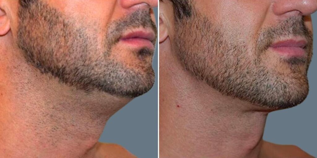 Skin Neck Liposuction Lift Male Pre2024 063 Before And After