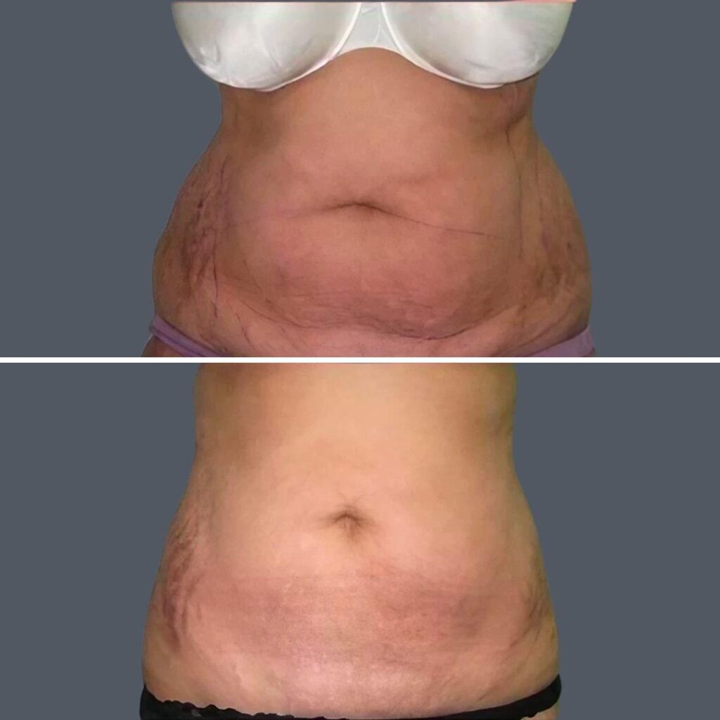 Skin Tightening Female Pre2024 002 Before And After