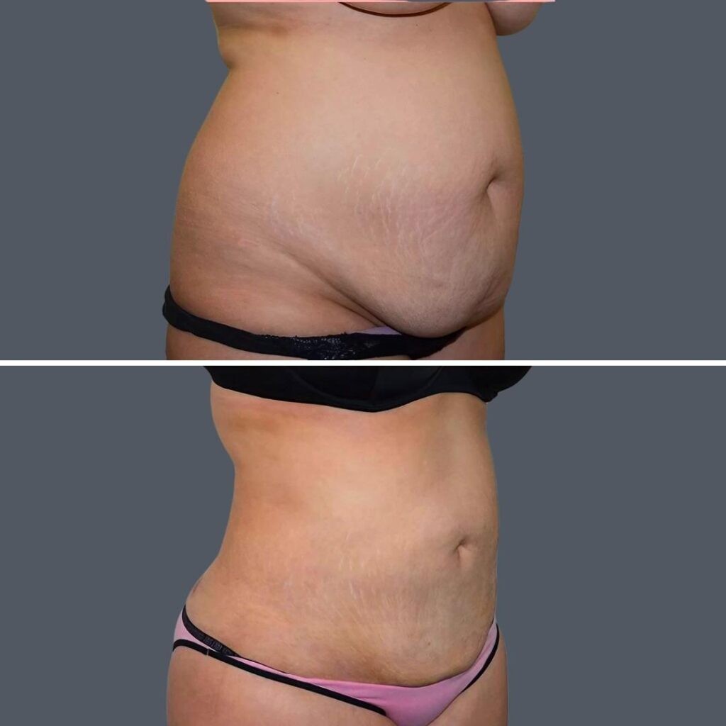 Skin Tightening Female Pre2024 003 Before And After