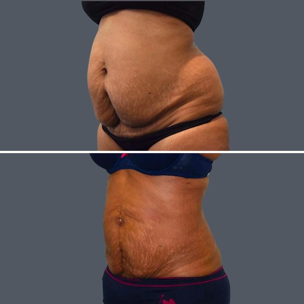 Skin Tightening Female Pre2024 004 Before And After