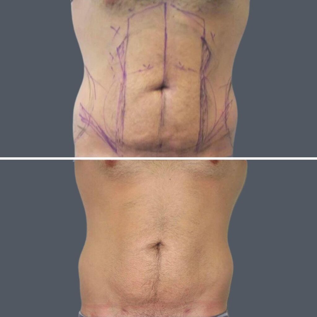 Skin Tightening Male Pre2024 001 Before And After