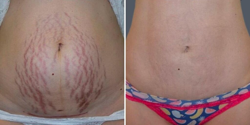 Stretch Marks Female Pre2024 001 Before And After