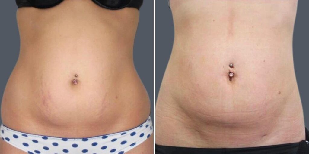 Stretch Marks Female Pre2024 003 Before And After
