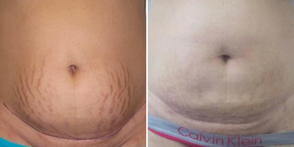 Stretch Marks Female Pre2024 004 Before And After