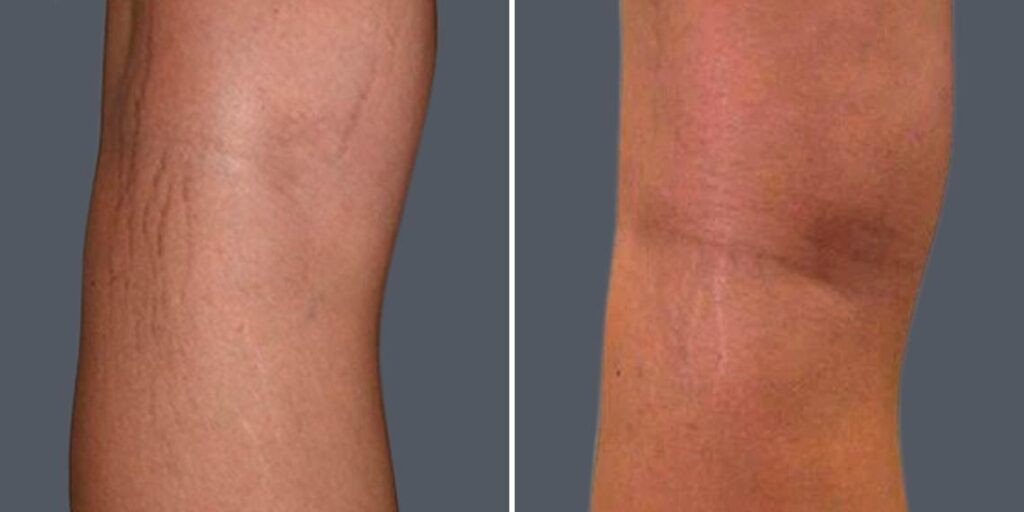 Stretch Marks Female Pre2024 005 Before And After