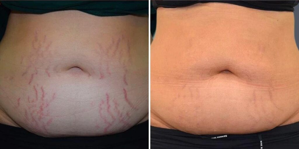 Stretch Marks Female Pre2024 007 Before And After