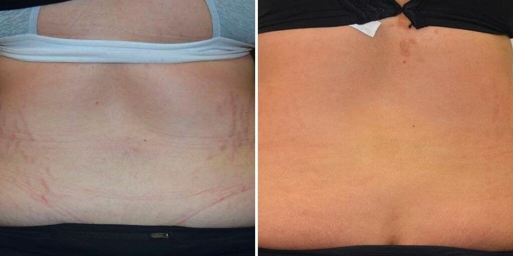 Stretch Marks Female Pre2024 008 Before And After