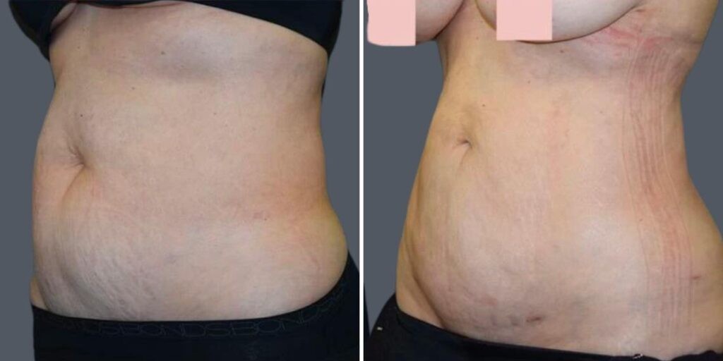 Stretch Marks Female Pre2024 010 Before And After