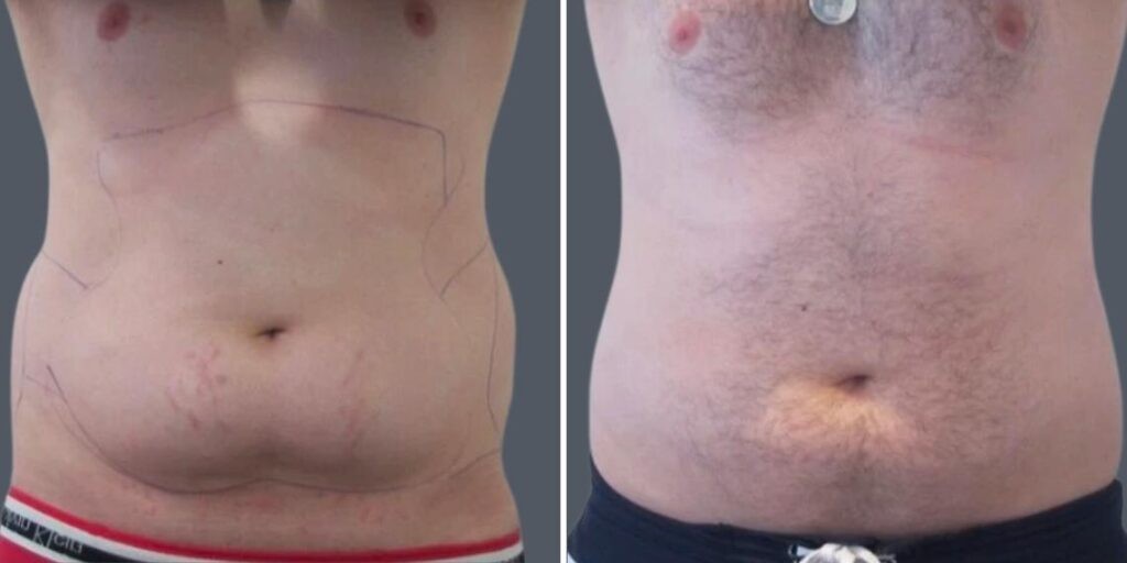 Stretch Marks Male Pre2024 002 Before And After