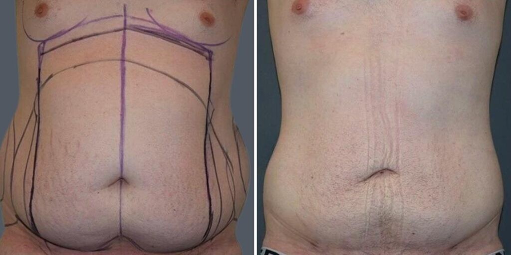 Stretch Marks Male Pre2024 006 Before And After