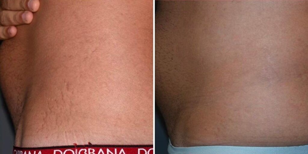 Stretch Marks Male Pre2024 010 Before And After