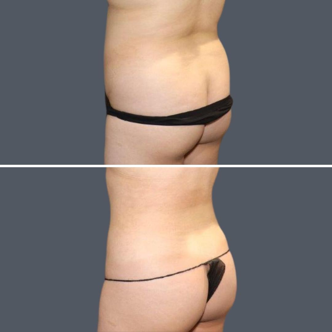 Back & Flanks Liposuction
