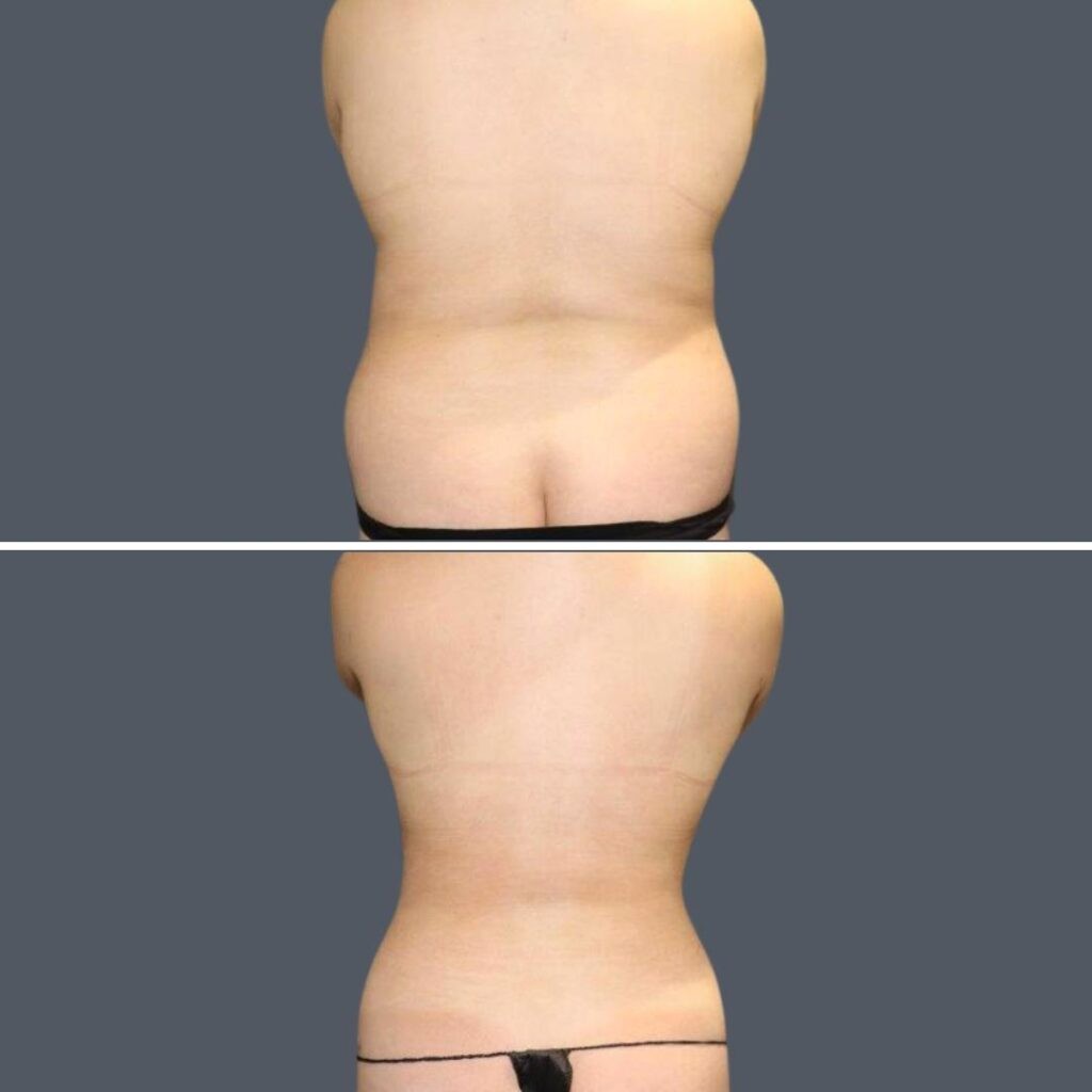 Sydney Back Liposuction Female 2024 Sg 006 Before And After