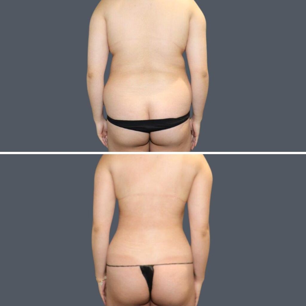 Sydney Back Liposuction Female 2024 Sg 007 Before And After