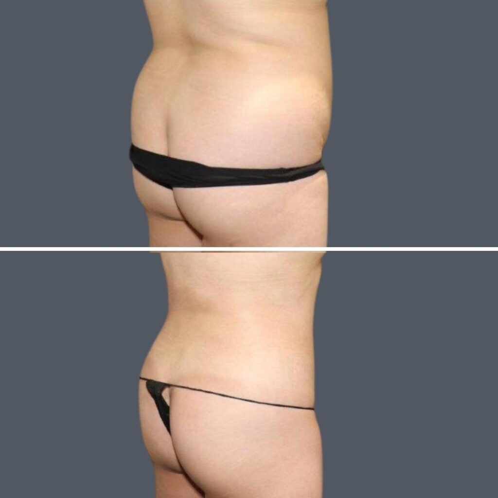 Sydney Back Liposuction Female 2024 Sg 008 Before And After
