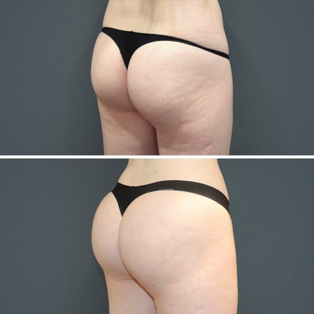 Sydney Bbl Butt Female 2023 Right Tc Before And After