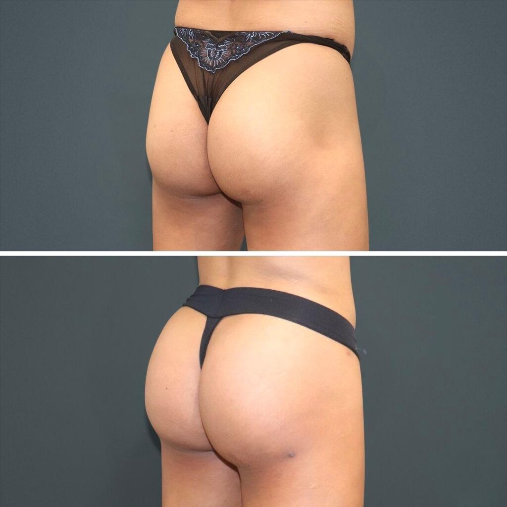 Sydney Bbl Butt Male 2021 Left Jg Before And After