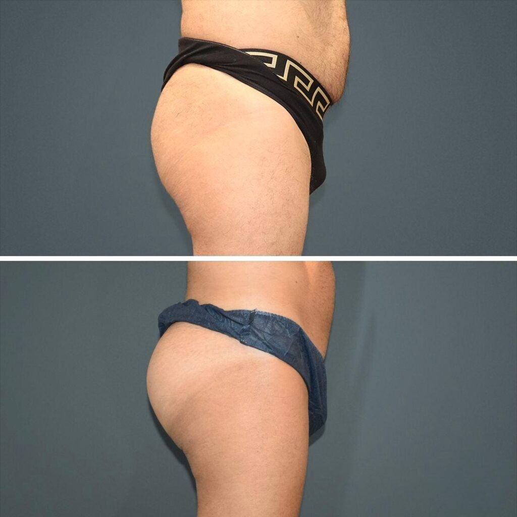 Sydney Bbl Butt Male 2021 Left Lj Before And After