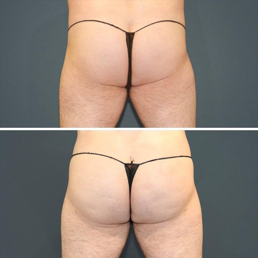 Sydney Bbl Butt Male 2021 Rear Jh Before And After