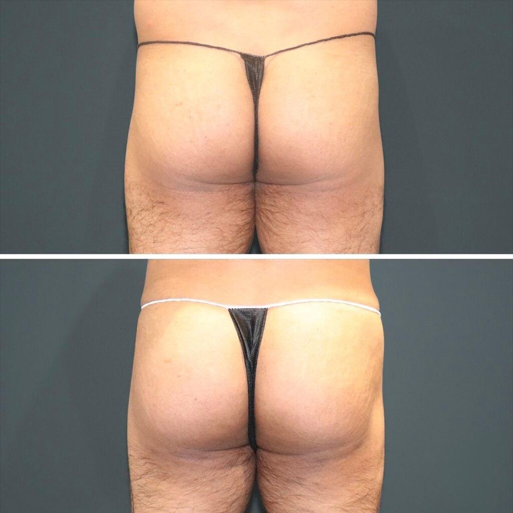 Sydney Bbl Butt Male 2021 Rear Jl Before And After