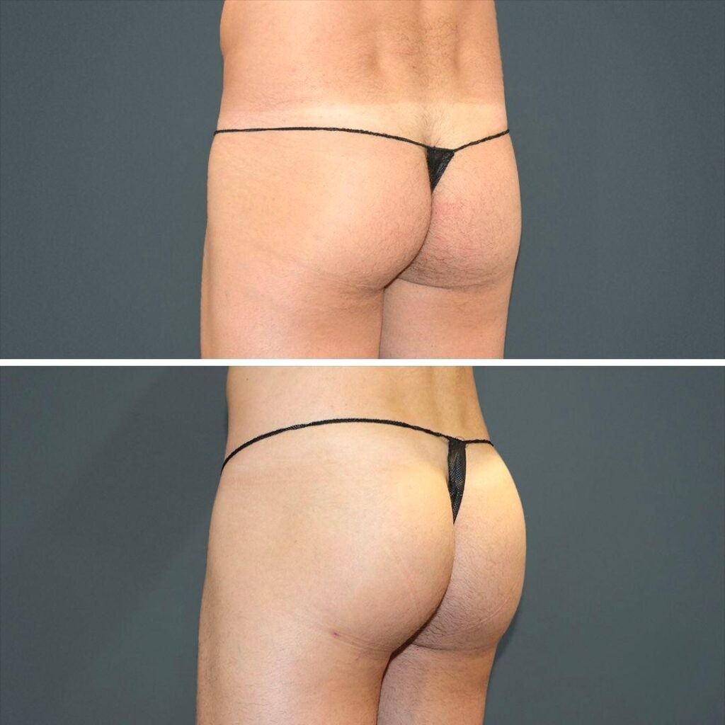 Sydney Bbl Butt Male 2021 Right Jt Before And After