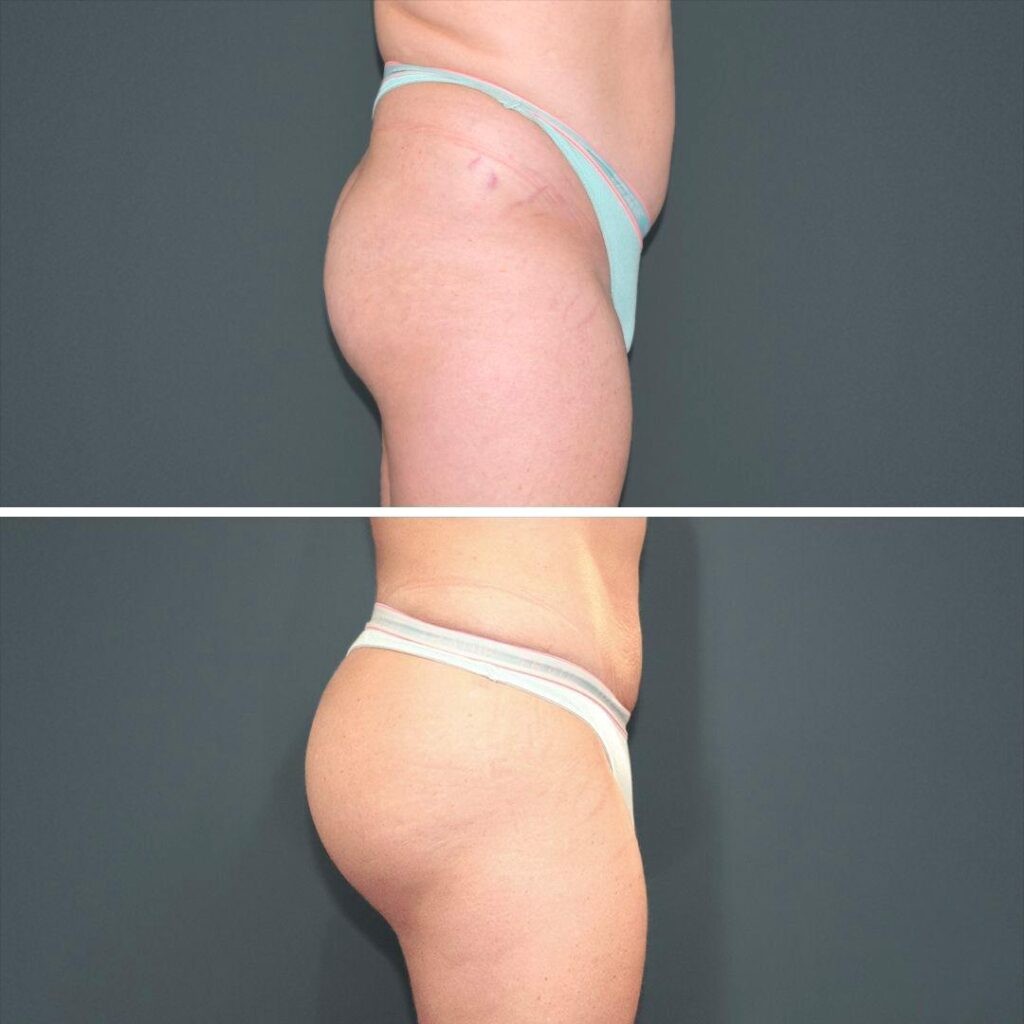 Sydney Bbl Butt Male 2022 Left Kb Before And After