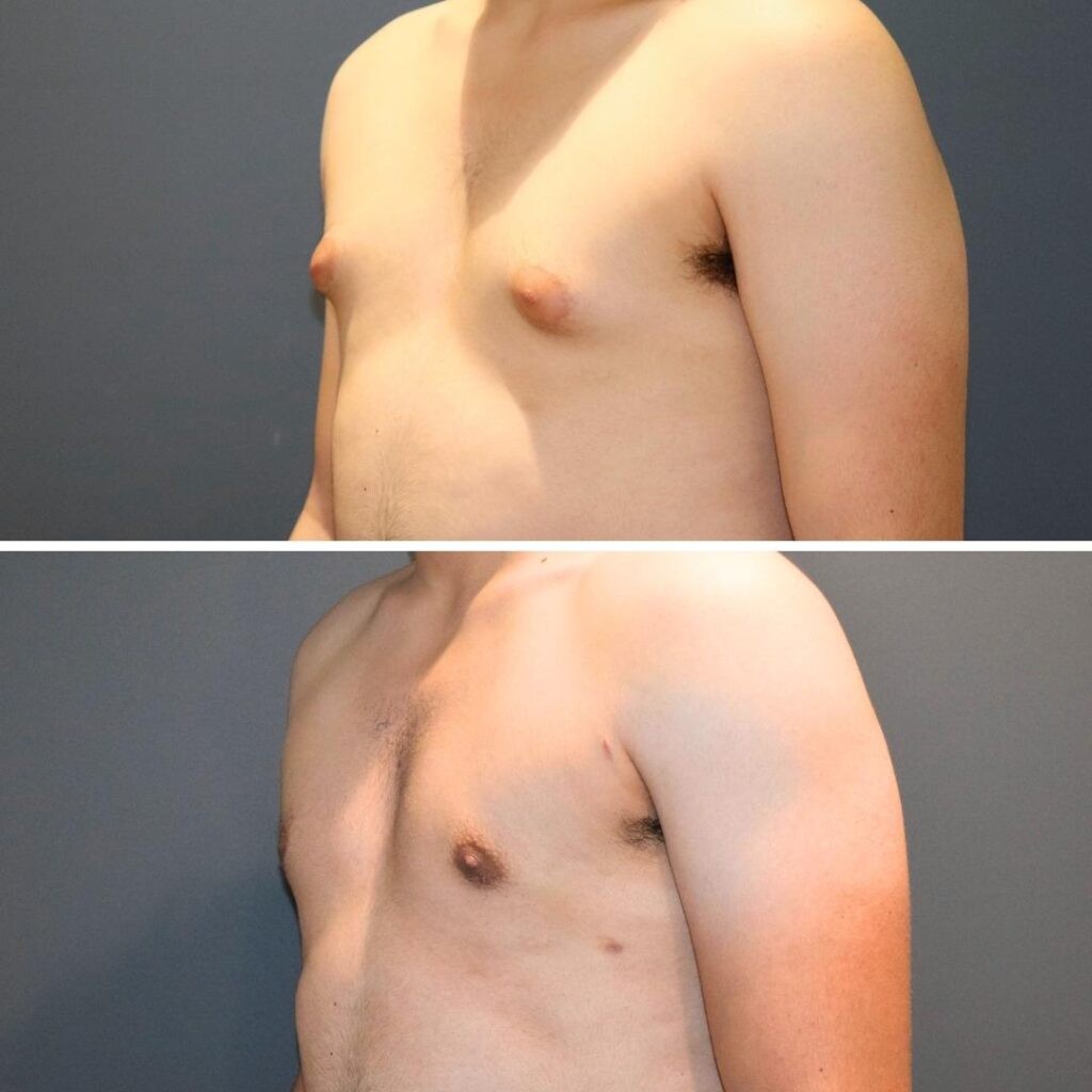 Sydney Gynecomastia Chest Male 2021 Right Mh Before And After