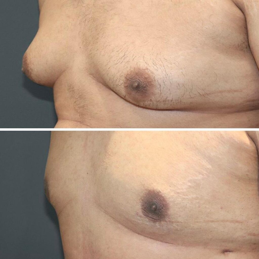 Sydney Gynecomastia Chest Male 2021 Right Mk Before And After