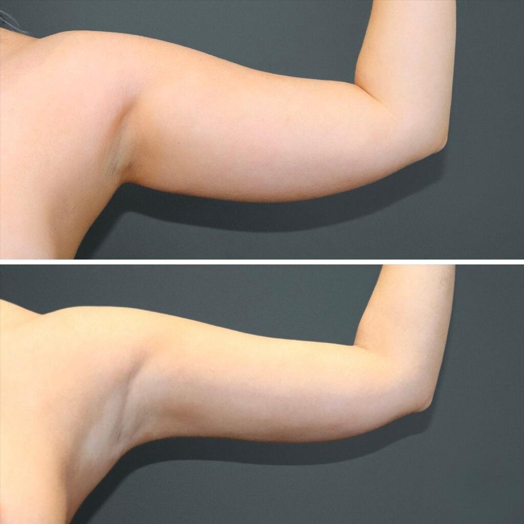 Sydney Liposuction Arm Female 2021 Right Ka Before And After
