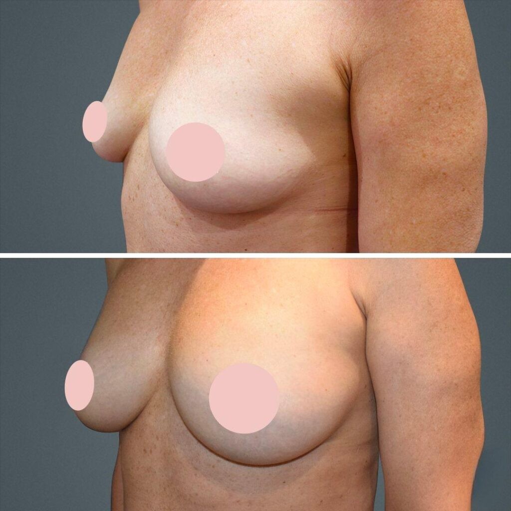 Sydney Liposuction Breast Female 2021 Right St Before And After