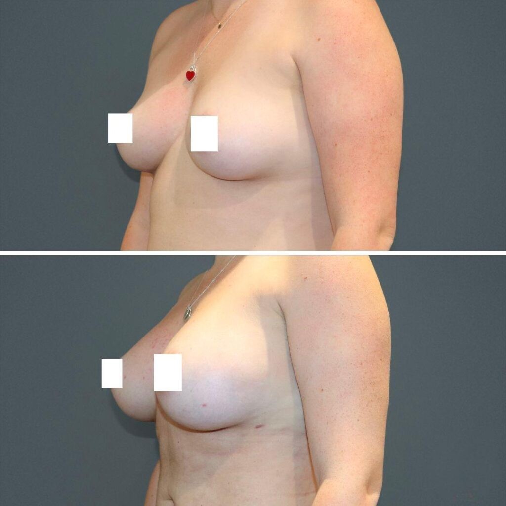 Sydney Liposuction Breast Female 2021 Right Tb Before And After