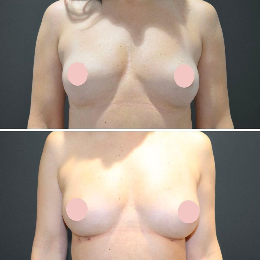 Sydney Liposuction Breast Female 2022 Front Nc Before And After