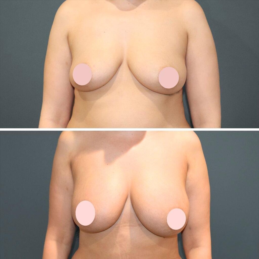 Sydney Liposuction Breast Female 2022 Front Zs Before And After