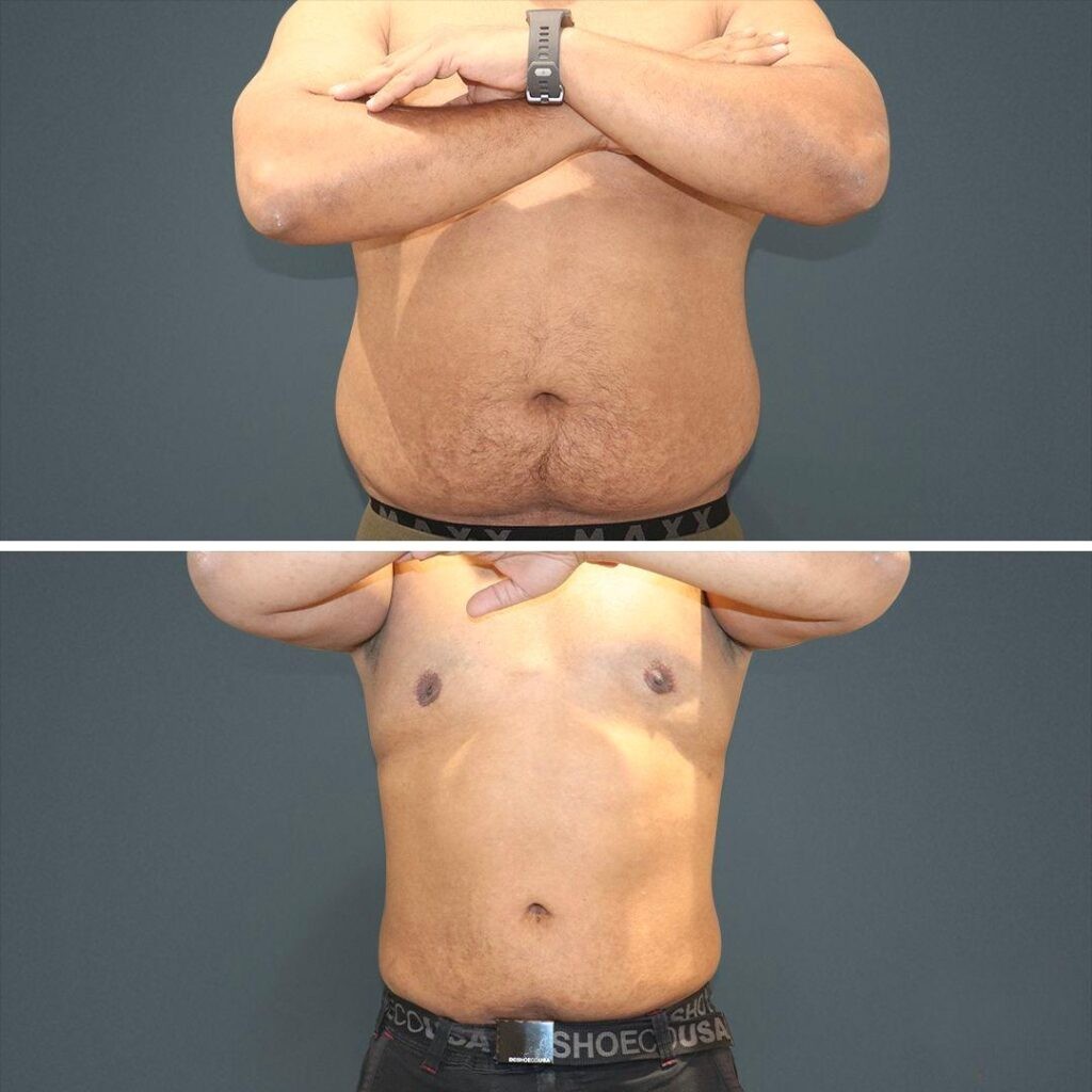 Sydney Liposuction Stomach Male 2022 Front Ym Before And After