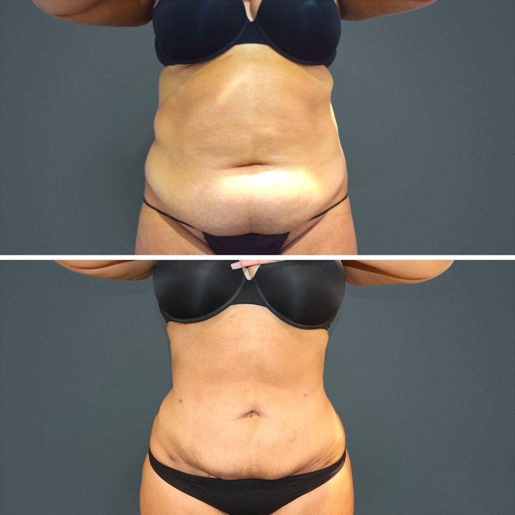 Sydney Megaliposuction Stomach Female 2021 Front Sg Before And After