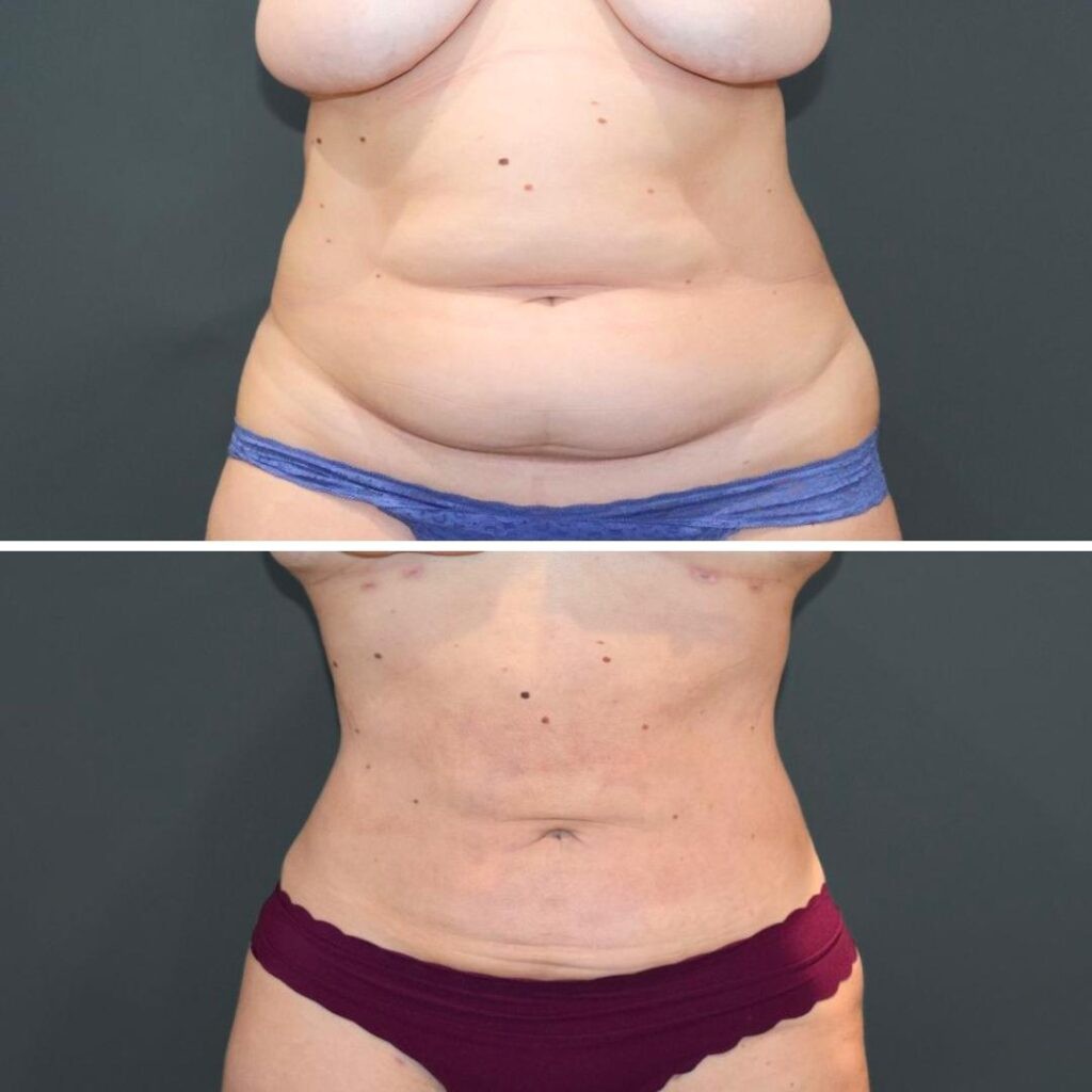 Sydney Megaliposuction Stomach Female 2021 Front Tb Before And After